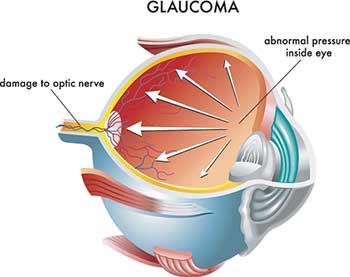 Glaucoma Treatment in Monterey