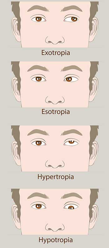 Amblyopia in Salinas