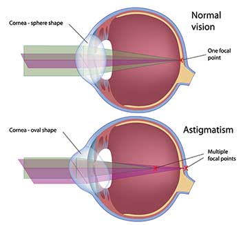 Monterey Astigmatism