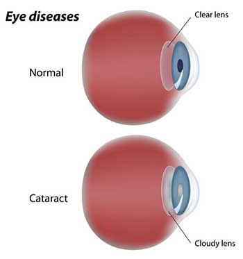 Cataracts in Salinas