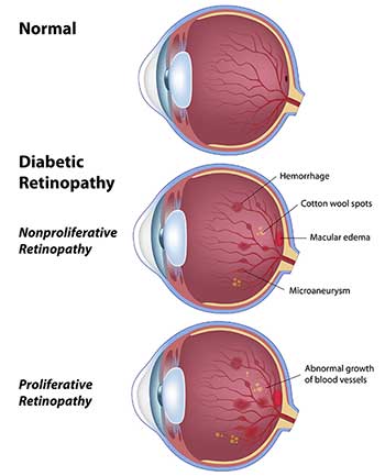 Diabetic Eye Care in Salinas