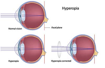 Farsightedness in Marina