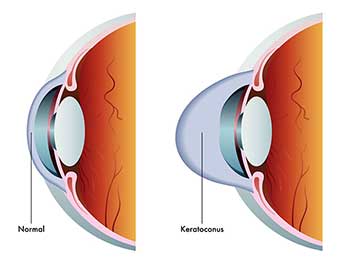 Salinas Keratoconus