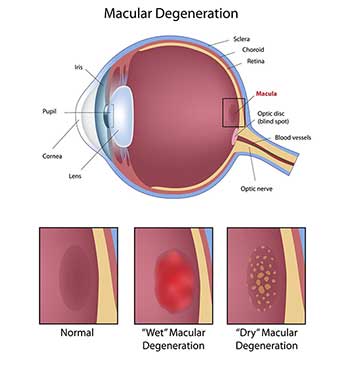 Macular Degeneration in Marina