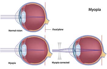 Nearsightedness in Monterey