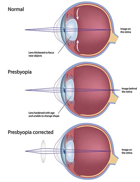 Presbyopia in Salinas